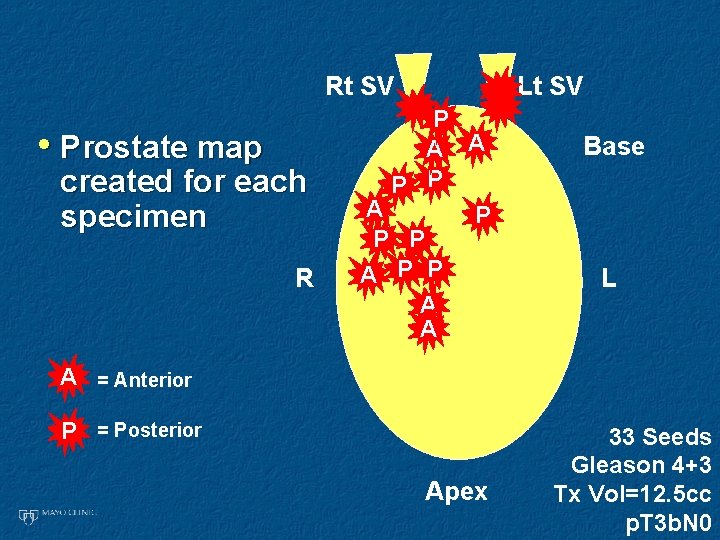 Rt SV • Prostate map created for each specimen R Lt SV P A