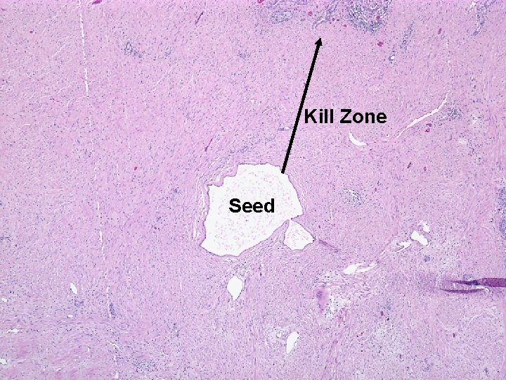 Kill Zone Seed 