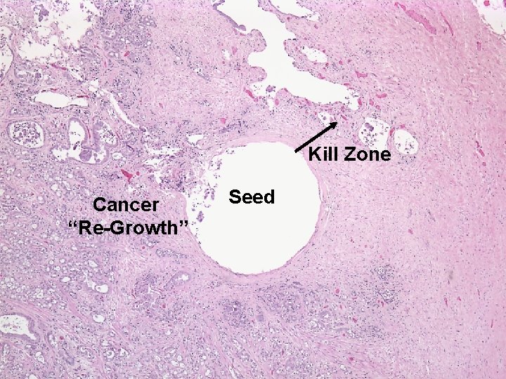 Kill Zone Cancer “Re-Growth” Seed 