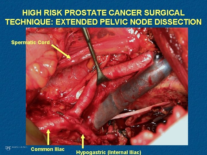 HIGH RISK PROSTATE CANCER SURGICAL TECHNIQUE: EXTENDED PELVIC NODE DISSECTION Spermatic Cord Common Iliac