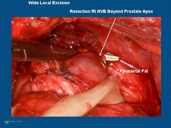 Wide Local Excision Resection Rt NVB Beyond Prostate Apex Pararectal Fat 