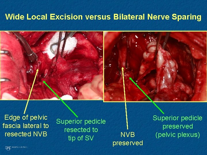 Wide Local Excision versus Bilateral Nerve Sparing Edge of pelvic fascia lateral to resected
