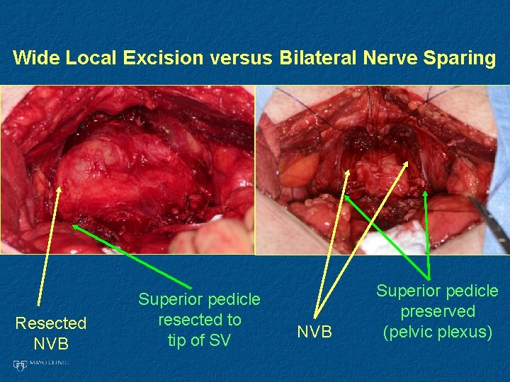 Wide Local Excision versus Bilateral Nerve Sparing Resected NVB Superior pedicle resected to tip