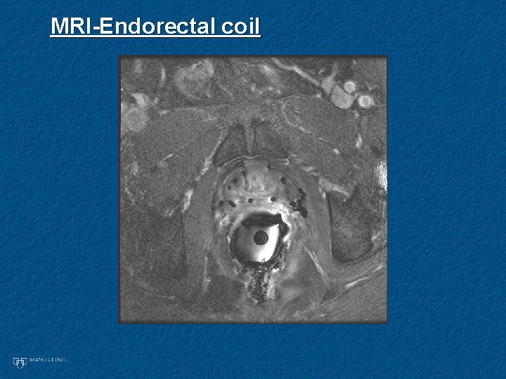 MRI-Endorectal coil 