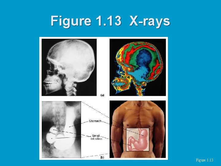 Figure 1. 13 X-rays Figure 1. 13 Figure 1. 13 X-rays Figure 1. 13