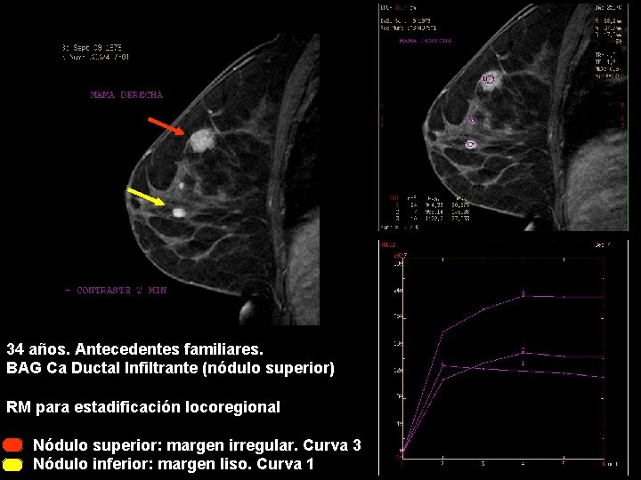 34 años. Antecedentes familiares. BAG Ca Ductal Infiltrante (nódulo superior) RM para estadificación locoregional