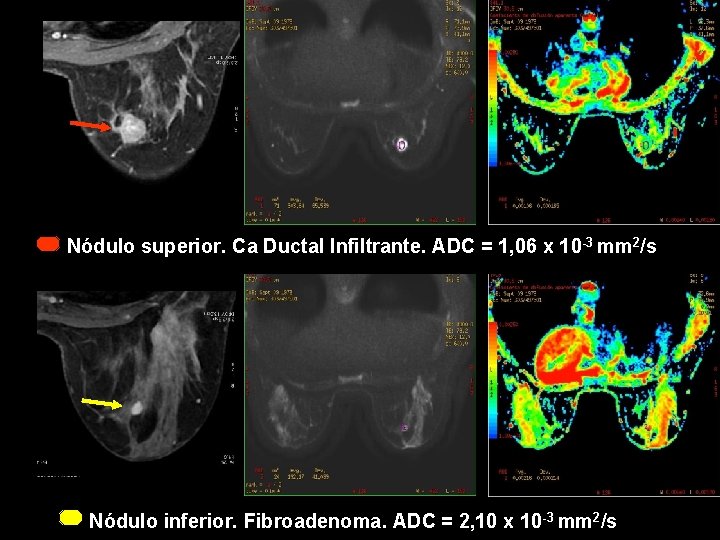 Nódulo superior. Ca Ductal Infiltrante. ADC = 1, 06 x 10 -3 mm 2/s