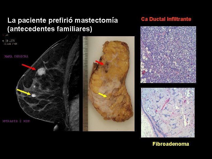 La paciente prefirió mastectomía (antecedentes familiares) Ca Ductal Infiltrante Fibroadenoma 