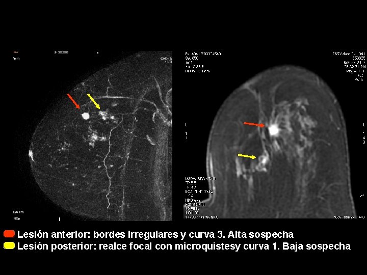 Lesión anterior: bordes irregulares y curva 3. Alta sospecha Lesión posterior: realce focal con