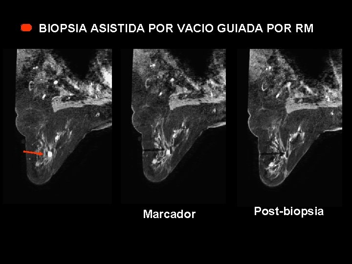 BIOPSIA ASISTIDA POR VACIO GUIADA POR RM Marcador Post-biopsia 