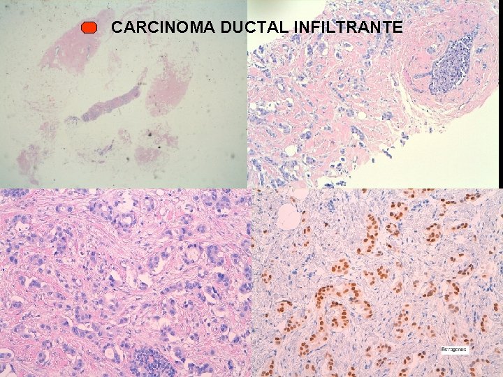 CARCINOMA DUCTAL INFILTRANTE 