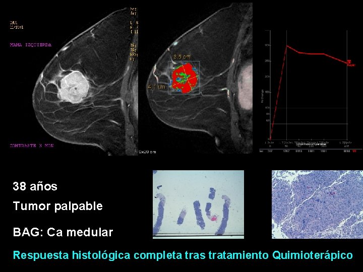 38 años Tumor palpable BAG: Ca medular Respuesta histológica completa tras tratamiento Quimioterápico 