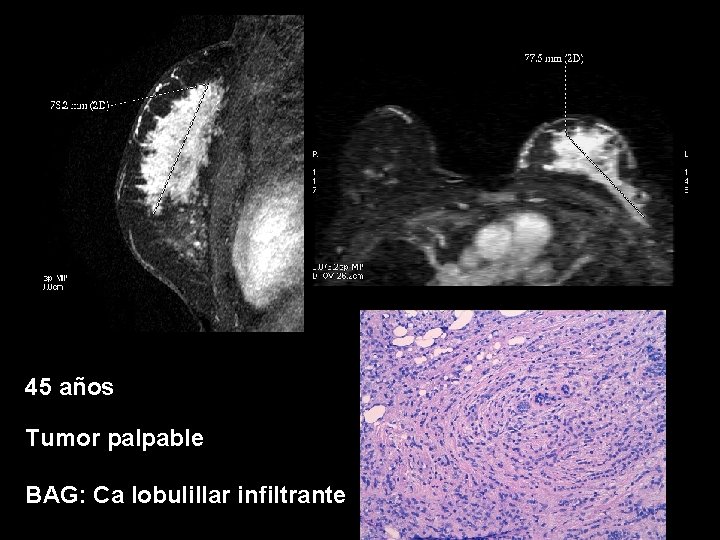 45 años Tumor palpable BAG: Ca lobulillar infiltrante 