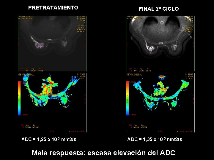 PRETRATAMIENTO ADC = 1, 25 x 10 -3 mm 2/s FINAL 2º CICLO ADC