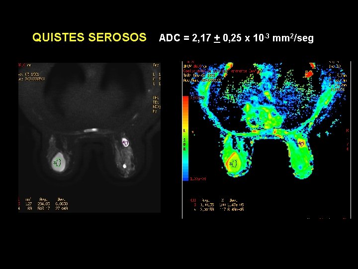 QUISTES SEROSOS ADC = 2, 17 + 0, 25 x 10 -3 mm 2/seg