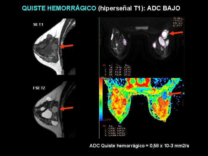 QUISTE HEMORRÁGICO (hiperseñal T 1): ADC BAJO SE T 1 FSE T 2 ADC