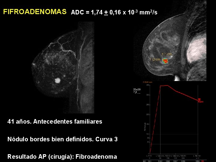 FIFROADENOMAS ADC = 1, 74 + 0, 16 x 10 -3 mm 2/s 41