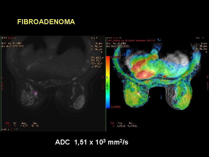 FIBROADENOMA ADC 1, 51 x 103 mm 2/s 