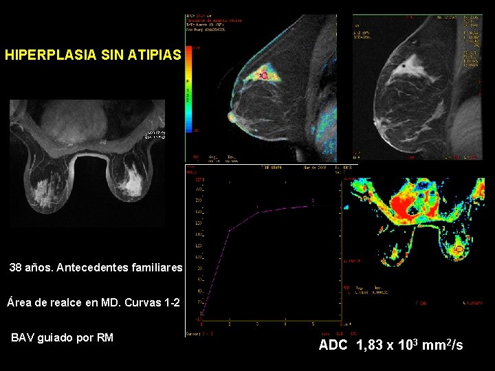 HIPERPLASIA SIN ATIPIAS 38 años. Antecedentes familiares Área de realce en MD. Curvas 1