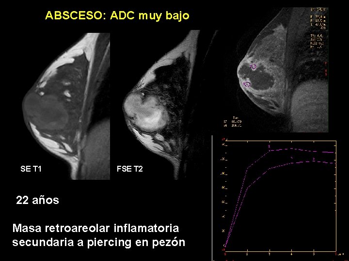 ABSCESO: ADC muy bajo SE T 1 FSE T 2 22 años Masa retroareolar