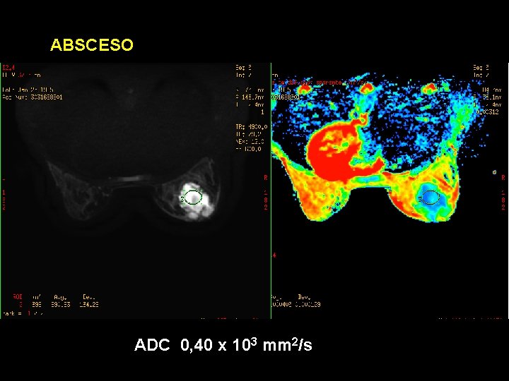 ABSCESO ADC 0, 40 x 103 mm 2/s 