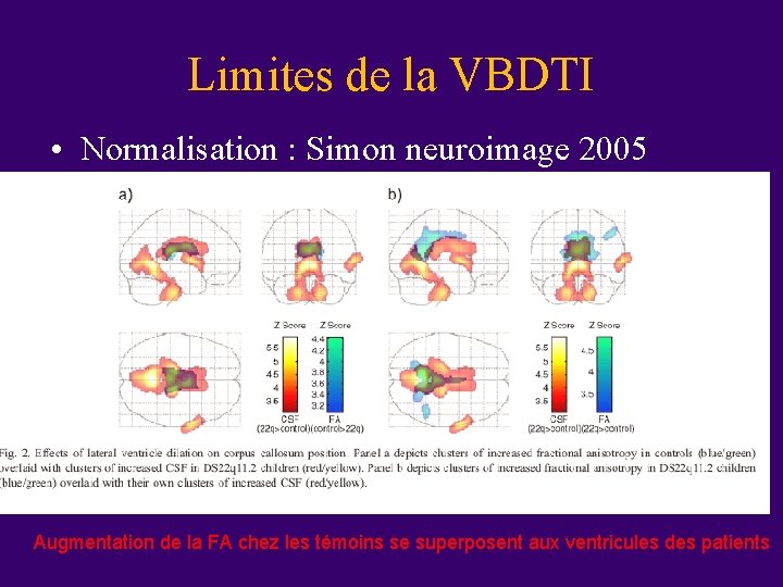 Limites de la VBDTI • Normalisation : Simon neuroimage 2005 Augmentation de la FA