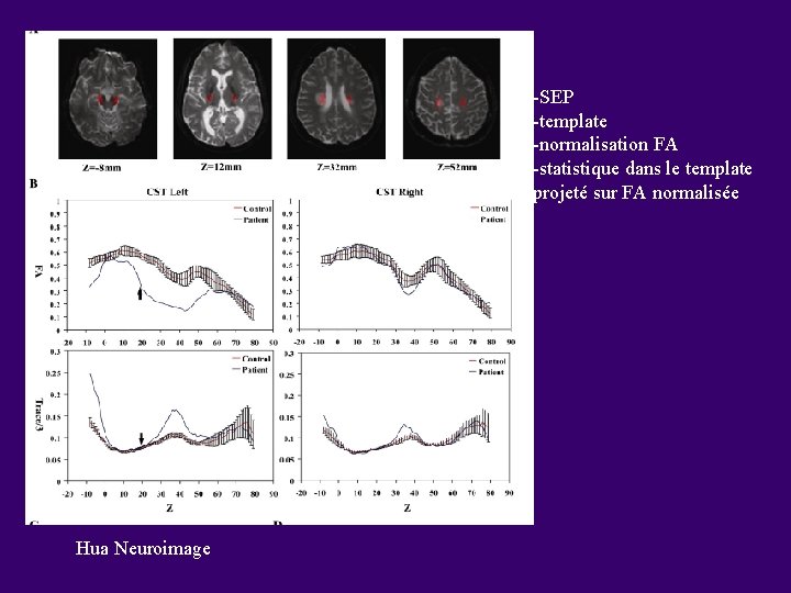 -SEP -template -normalisation FA -statistique dans le template projeté sur FA normalisée Hua Neuroimage