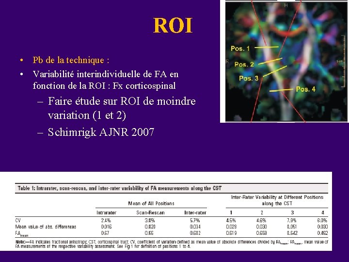 ROI • Pb de la technique : • Variabilité interindividuelle de FA en fonction ROI • Pb de la technique : • Variabilité interindividuelle de FA en fonction