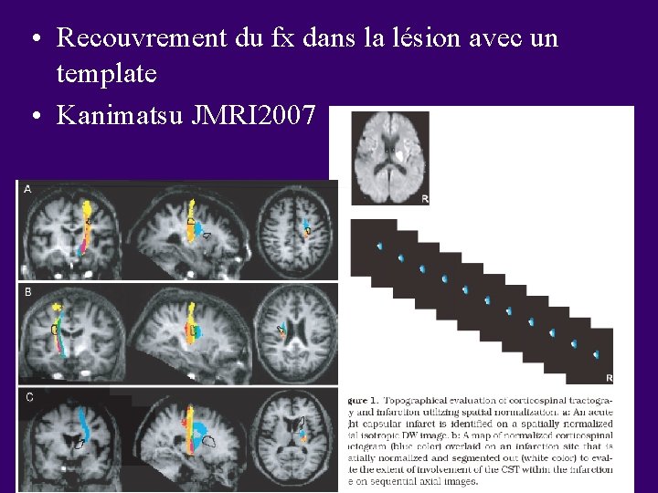  • Recouvrement du fx dans la lésion avec un template • Kanimatsu JMRI