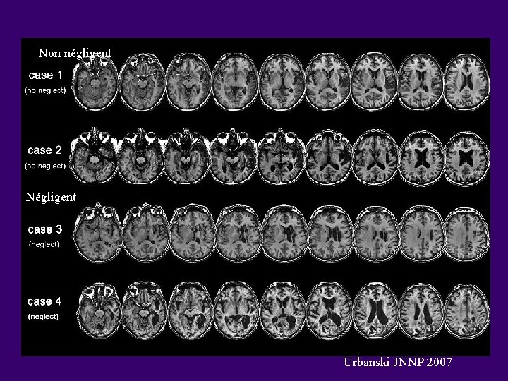 Non négligent Négligent Urbanski JNNP 2007 