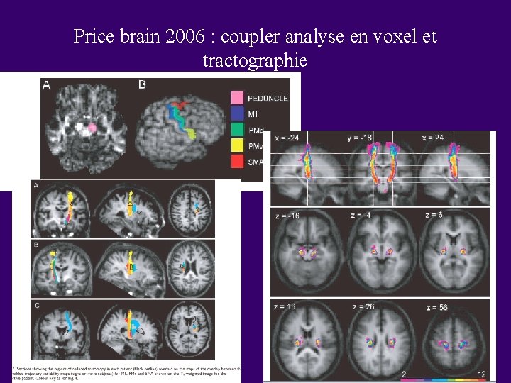 Price brain 2006 : coupler analyse en voxel et tractographie Price brain 2006 : coupler analyse en voxel et tractographie