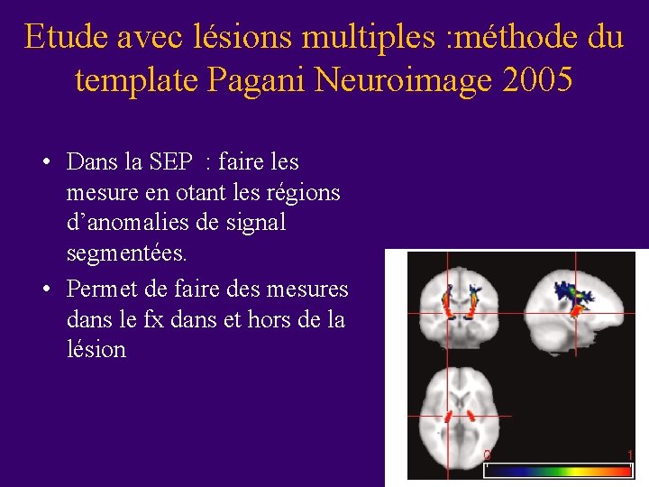 Etude avec lésions multiples : méthode du template Pagani Neuroimage 2005 • Dans la