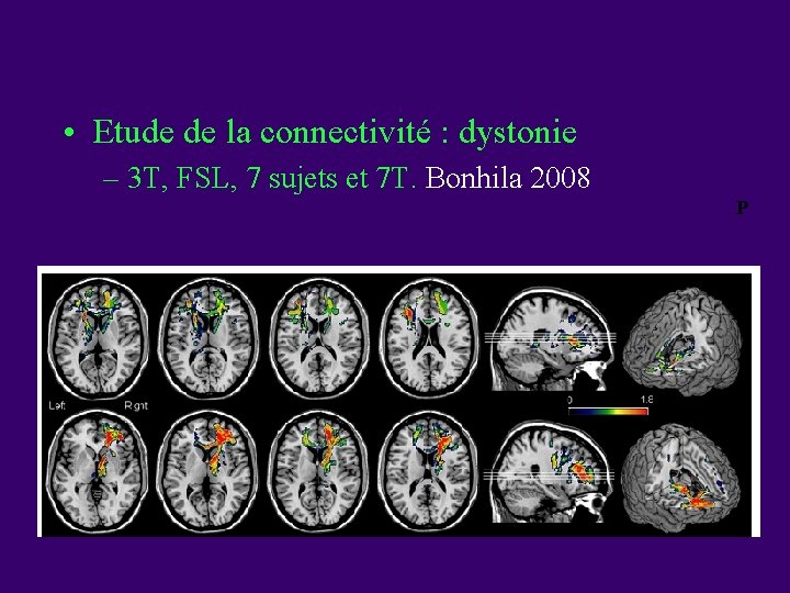  • Etude de la connectivité : dystonie – 3 T, FSL, 7 sujets