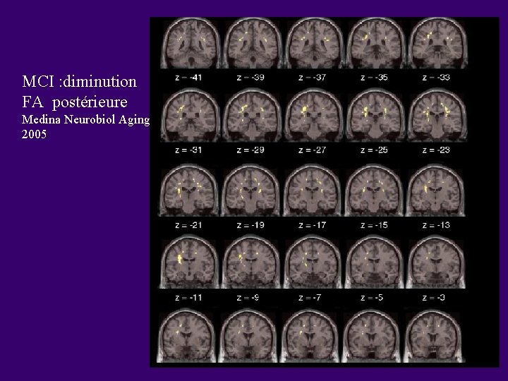 MCI : diminution FA postérieure Medina Neurobiol Aging 2005 