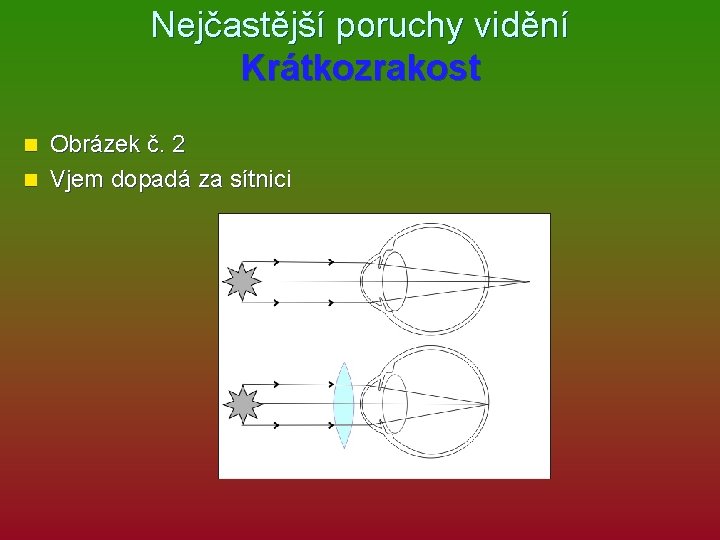Nejčastější poruchy vidění Krátkozrakost Obrázek č. 2 n Vjem dopadá za sítnici n 