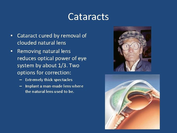 Cataracts • Cataract cured by removal of clouded natural lens • Removing natural lens