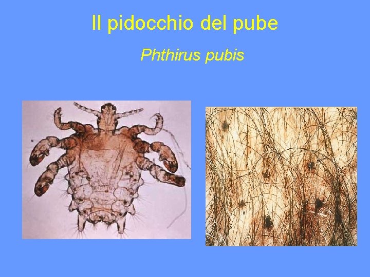 Il pidocchio del pube Phthirus pubis 