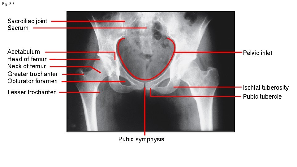 Fig. 8. 8 Sacroiliac joint Sacrum Acetabulum Head of femur Neck of femur Greater