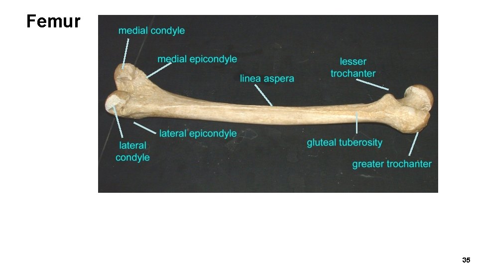 Femur Greater trochanter 35 