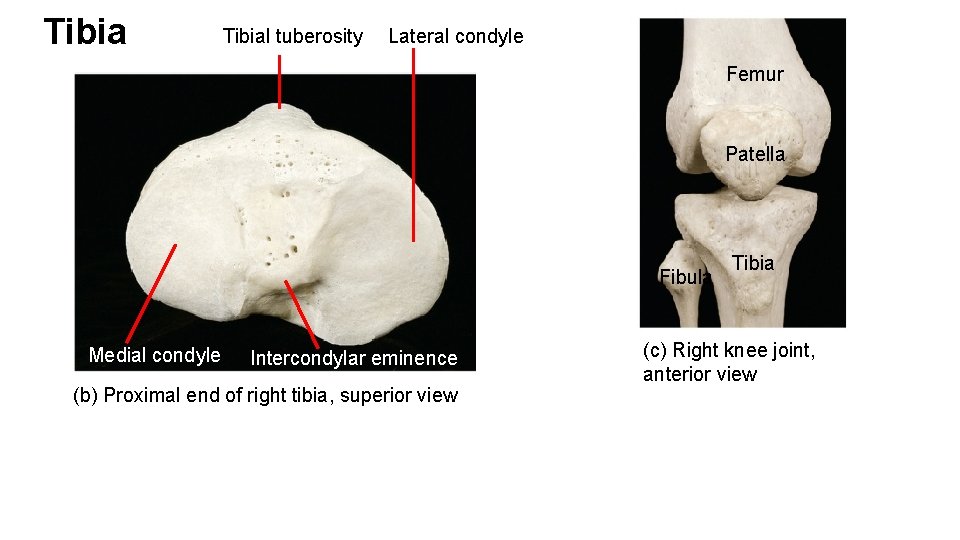 Tibial tuberosity Lateral condyle Femur Patella Fibula Medial condyle Intercondylar eminence (b) Proximal end