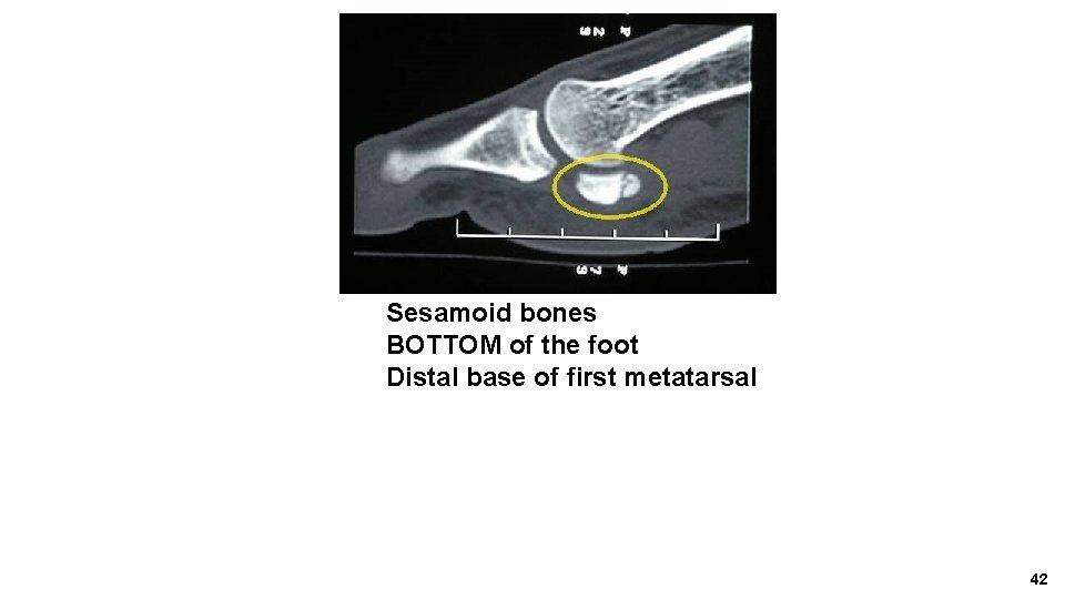 Sesamoid bones BOTTOM of the foot Distal base of first metatarsal 42 
