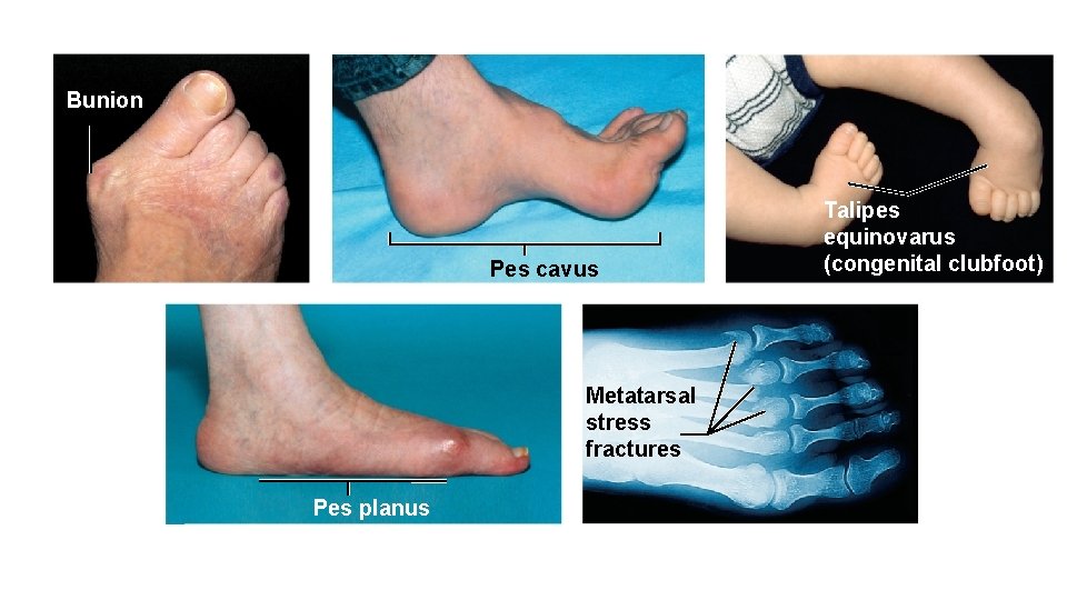 Bunion Pes cavus Metatarsal stress fractures Pes planus Talipes equinovarus (congenital clubfoot) 