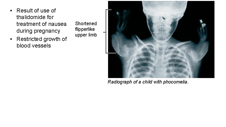  • Result of use of thalidomide for treatment of nausea during pregnancy •