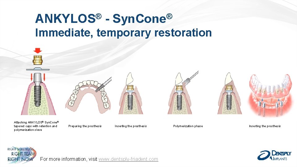 ANKYLOS® - Syn. Cone® Immediate, temporary restoration Attaching ANKYLOS® Syn. Cone® tapered caps with