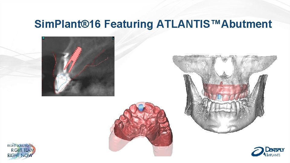 Sim. Plant® 16 Featuring ATLANTIS™Abutment 
