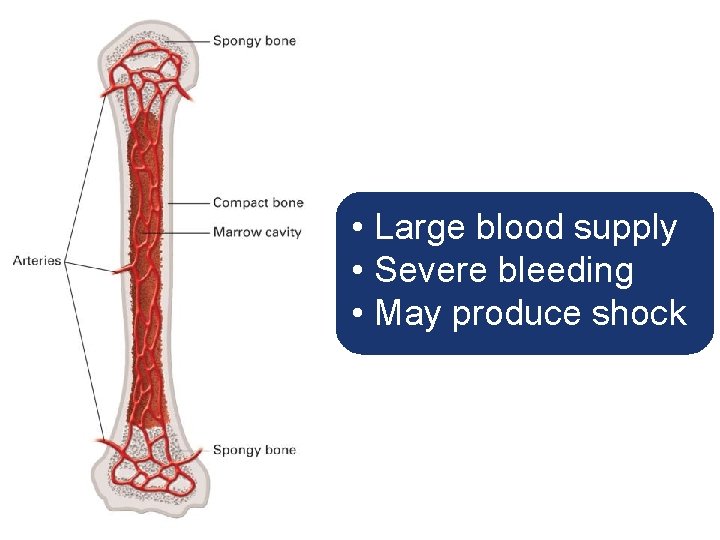  • Large blood supply • Severe bleeding • May produce shock 