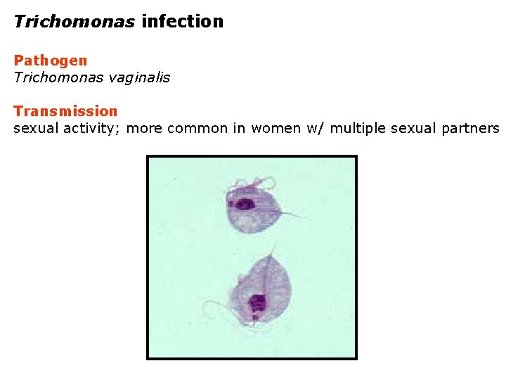 Trichomonas infection Pathogen Trichomonas vaginalis Transmission sexual activity; more common in women w/ multiple
