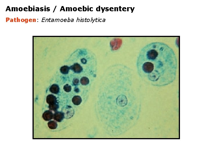 Amoebiasis / Amoebic dysentery Pathogen: Entamoeba histolytica 