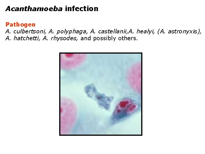 Acanthamoeba infection Pathogen A. culbertsoni, A. polyphaga, A. castellanii, A. healyi, (A. astronyxis), A.