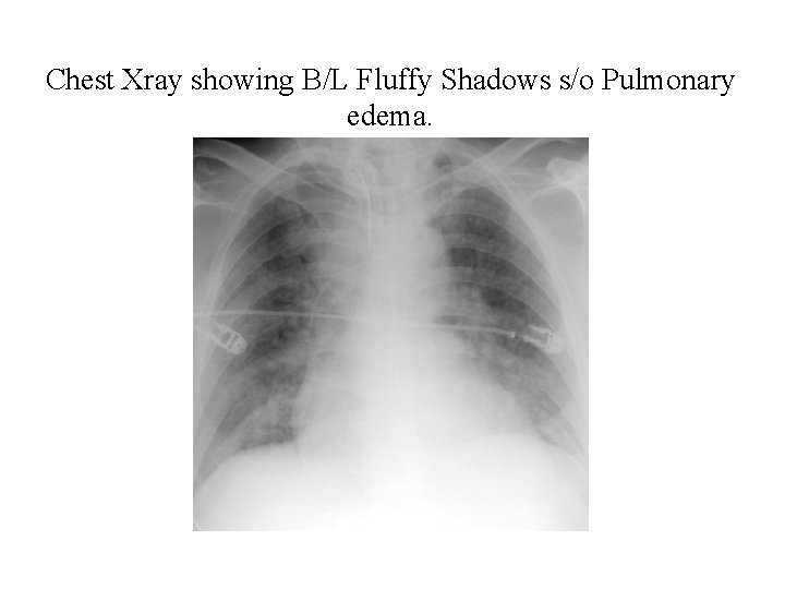 Chest Xray showing B/L Fluffy Shadows s/o Pulmonary edema. 